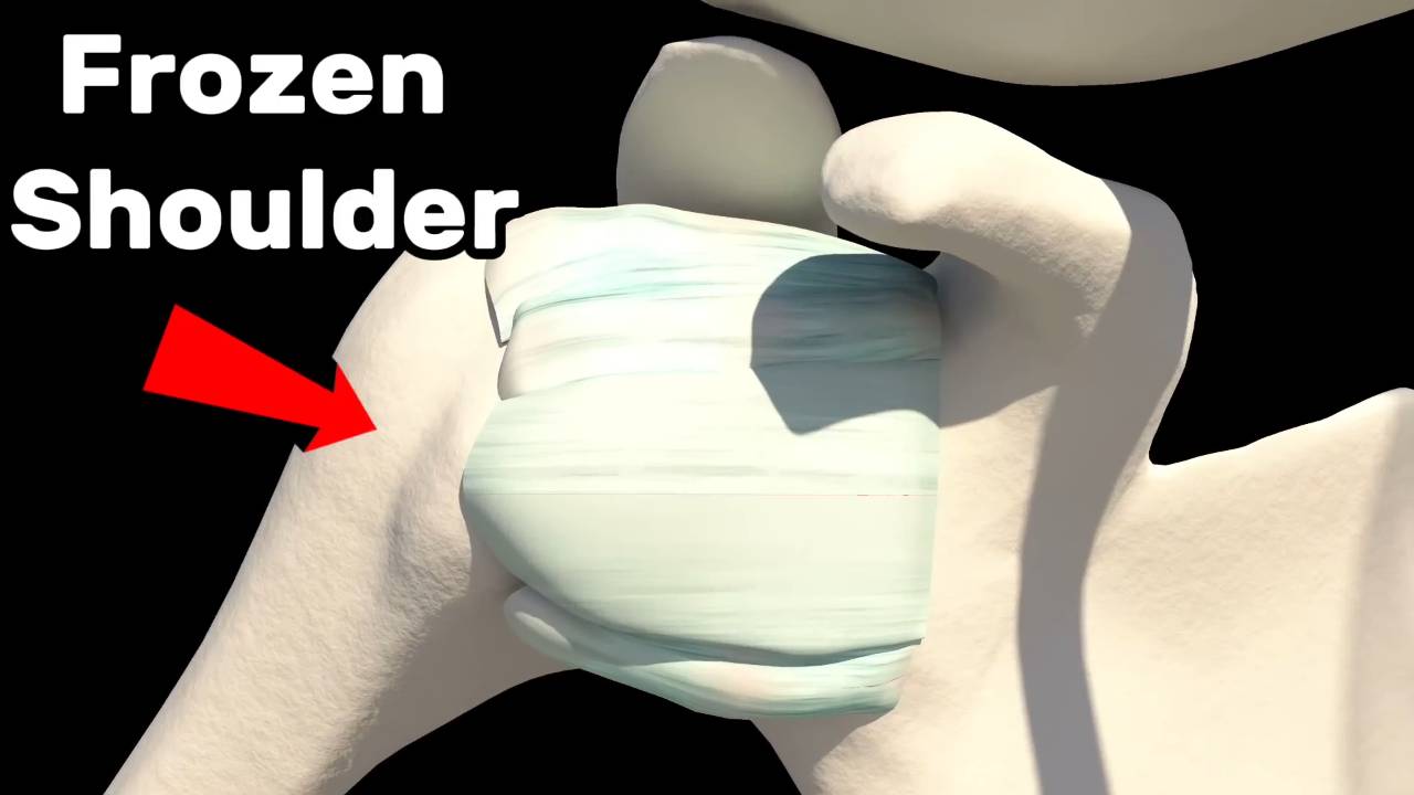 Frozen shoulder how to fix it - Causes and treatments 