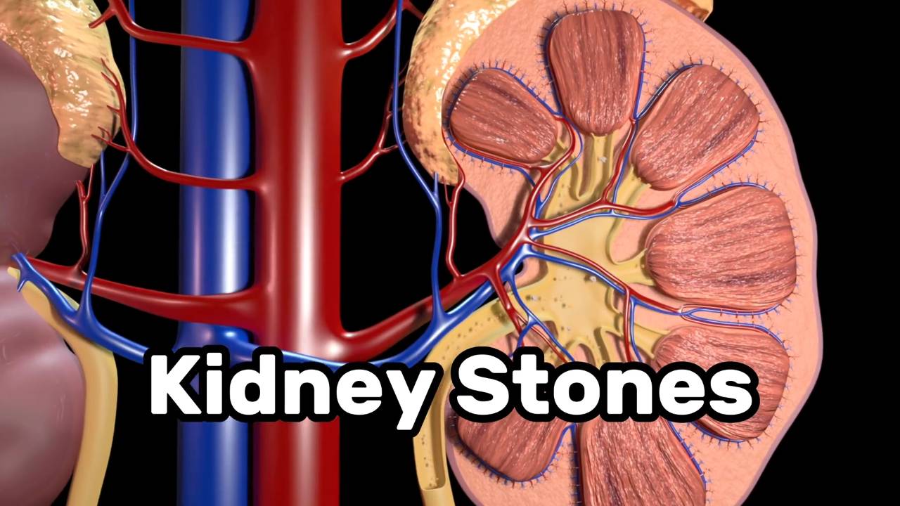 Kidney stones _ Treatments and why you get them 