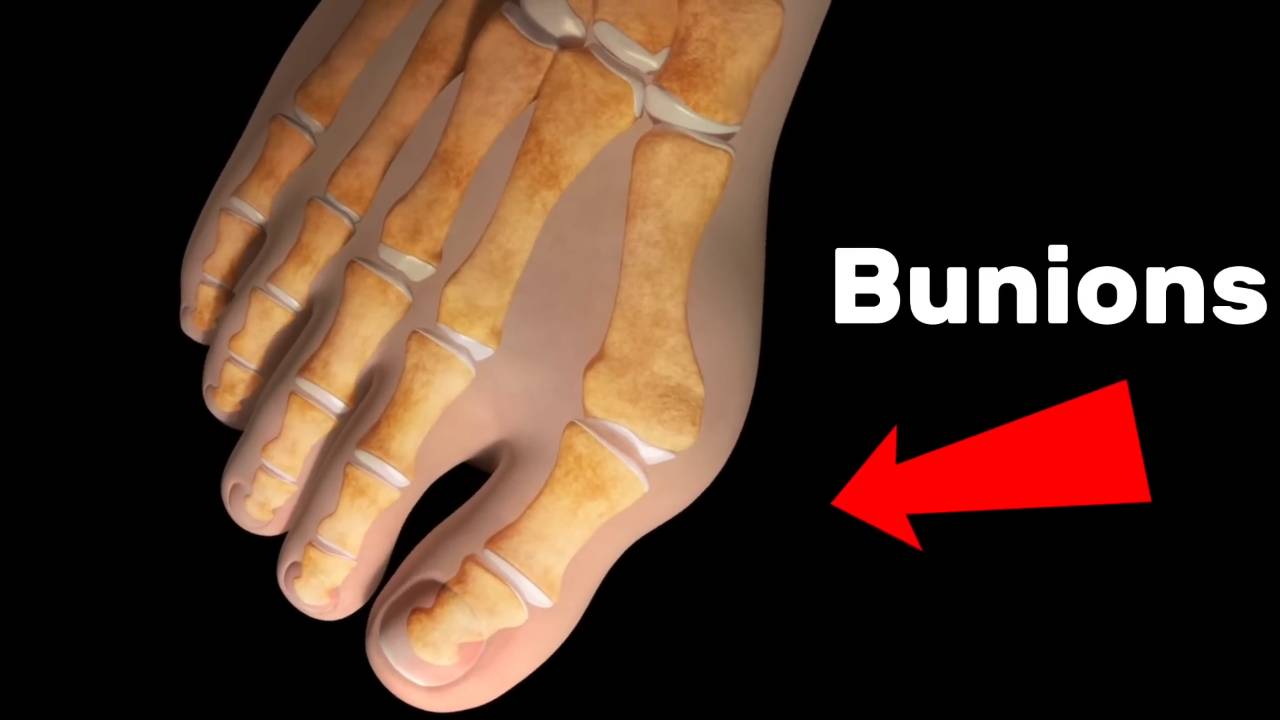 Bunions causes and treatments _ Doctors explain