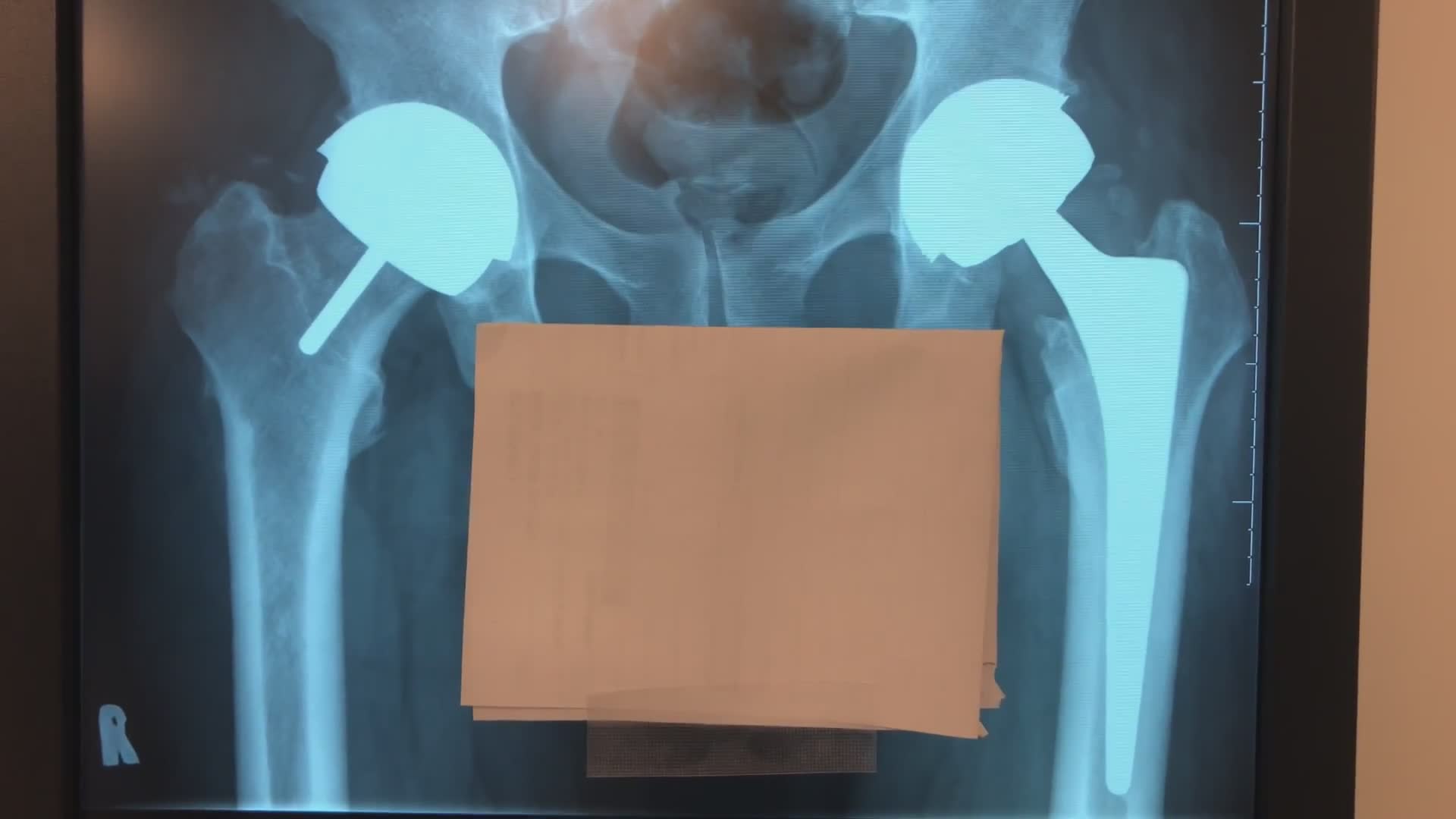 Understanding your hip surgery options