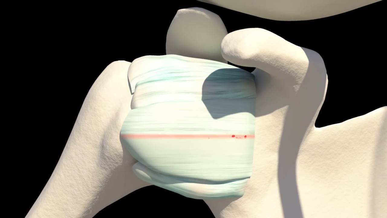 Understanding frozen shoulder syndrome: what causes it and proven treatment approaches