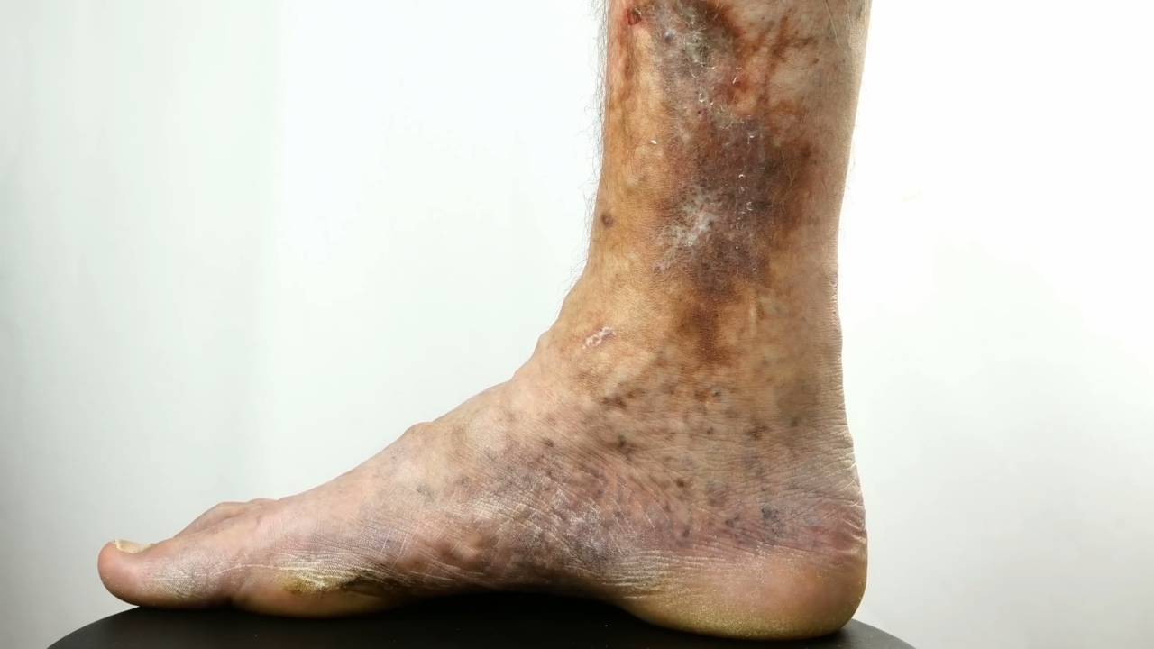 Venous ulcers and varicose veins: comprehensive guide to causes and effective treatments