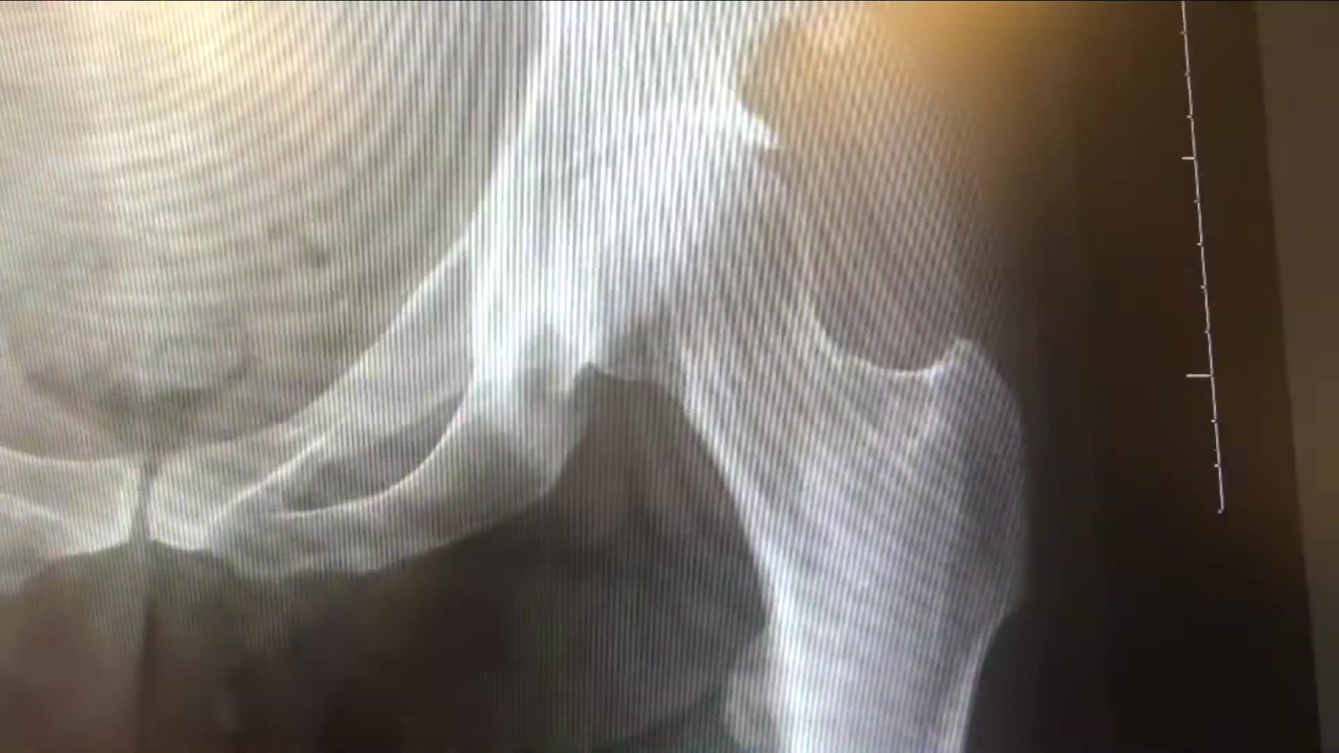 Developmental hip dysplasia: early detection importance and treatment in infancy