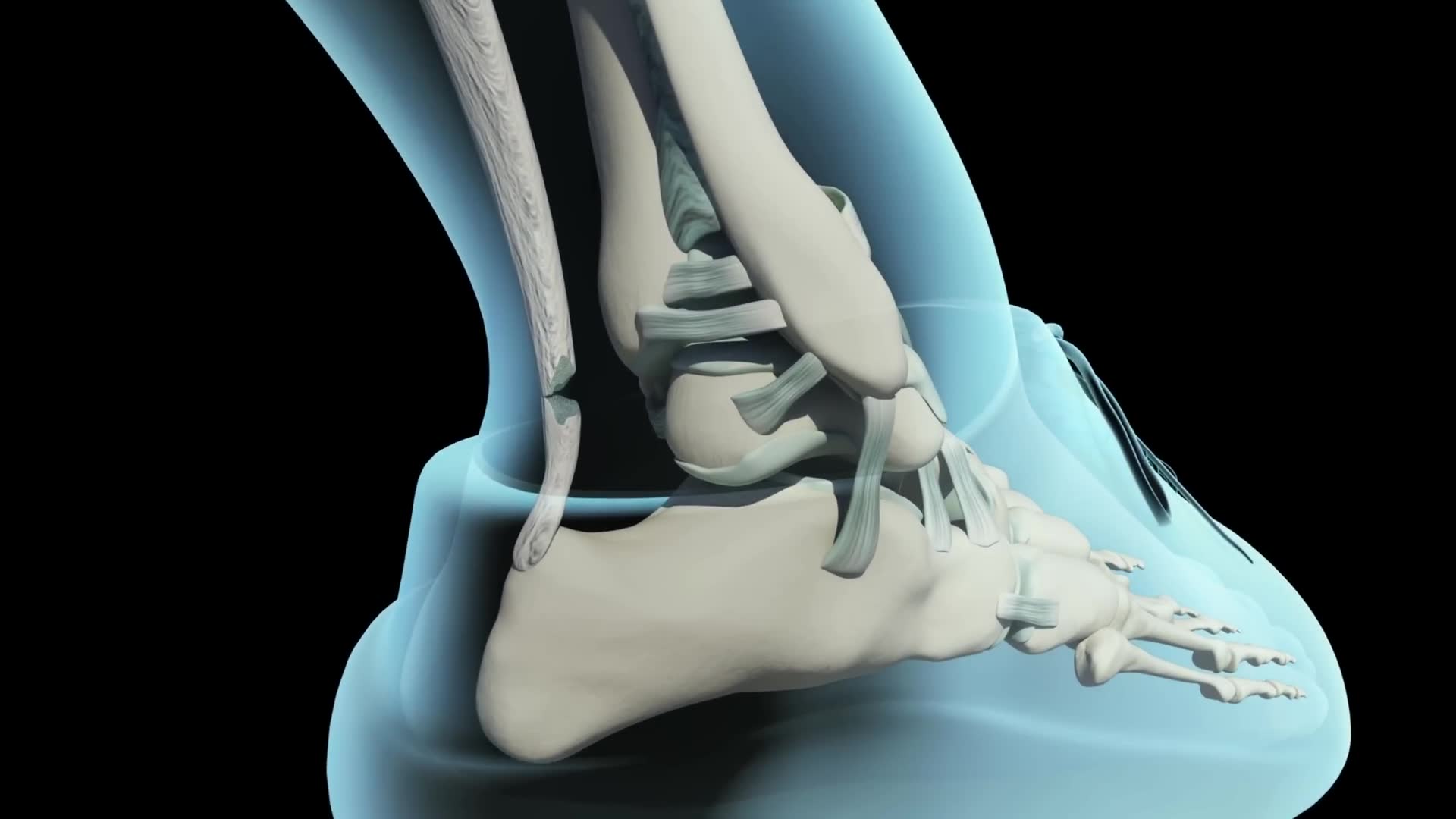 Comparing surgical and non-surgical treatment for achilles tears