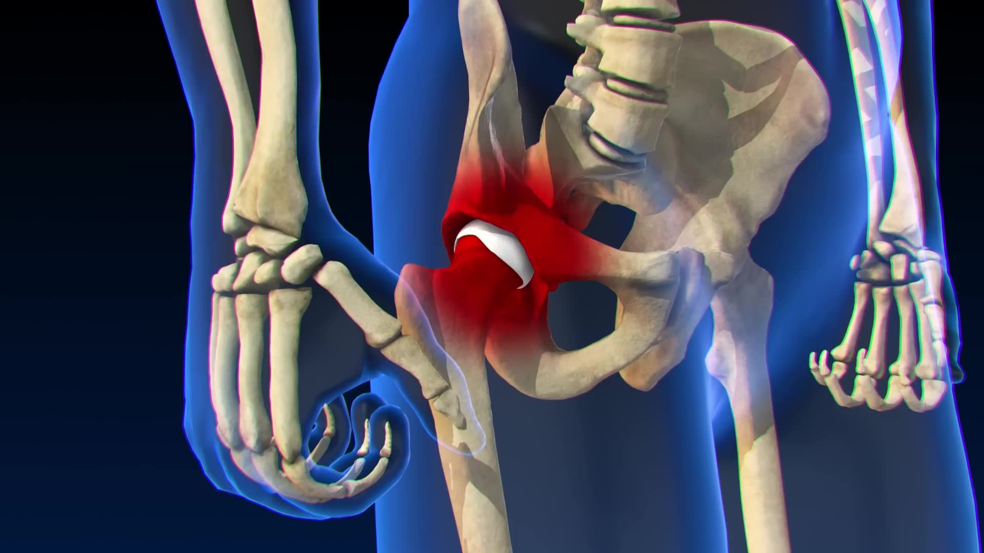 Step-by-step explanation of hip replacement procedure
