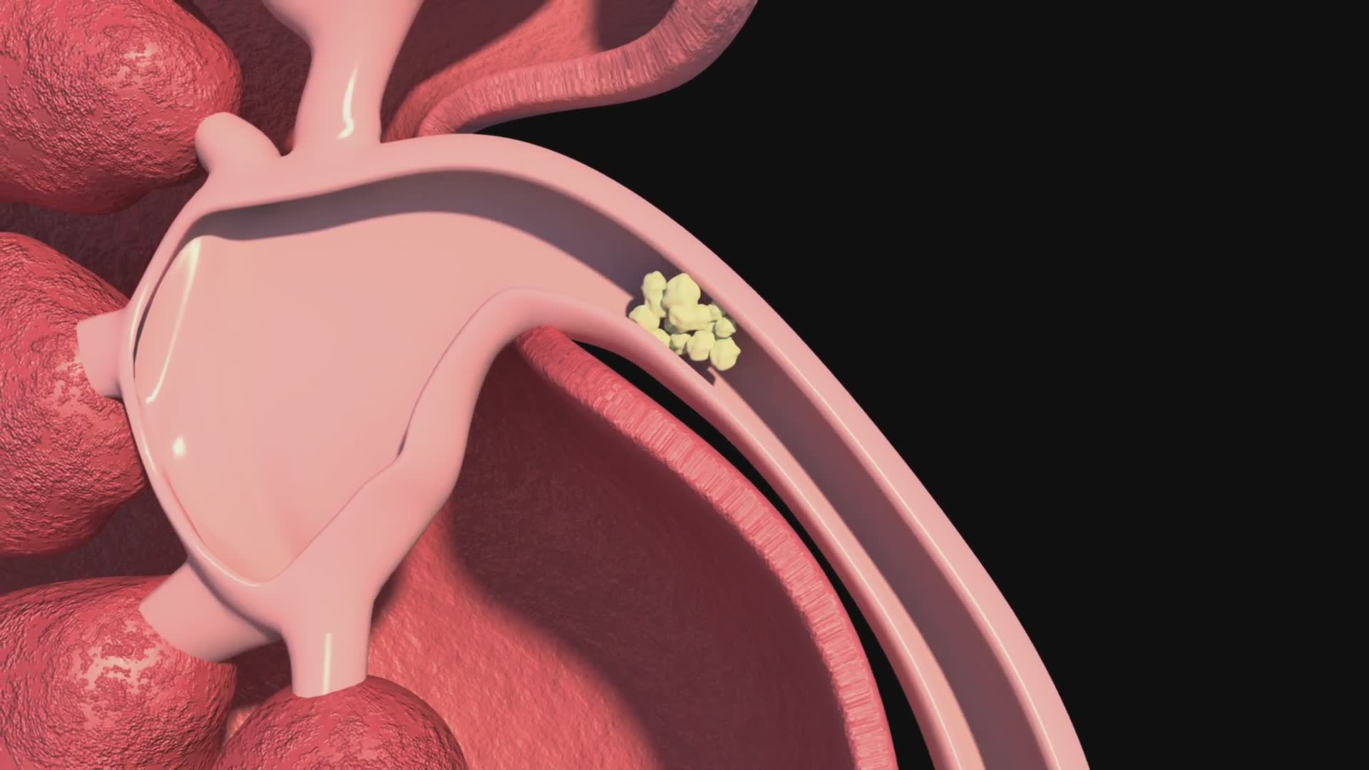 Kidney stone prevention and treatment
