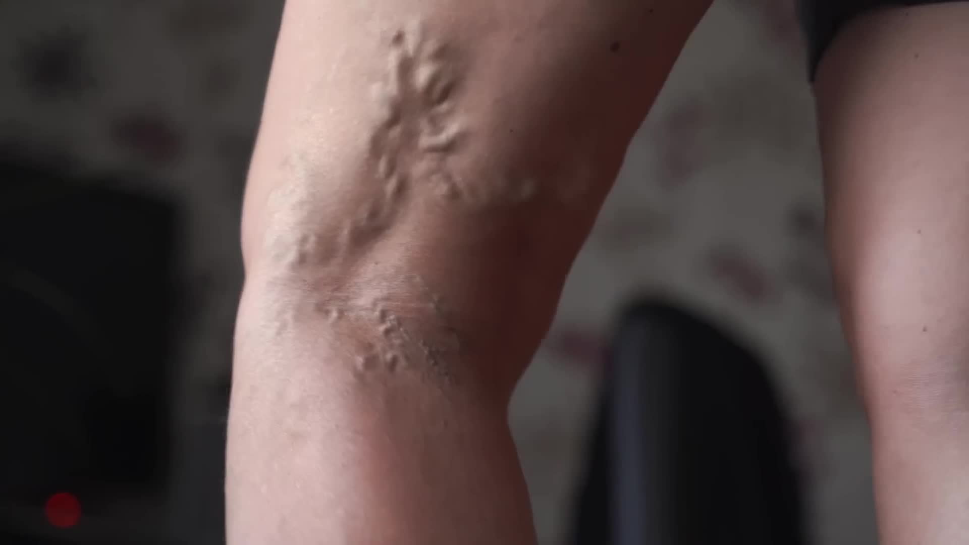 Treatment options for enlarged and twisted leg veins causing discomfort