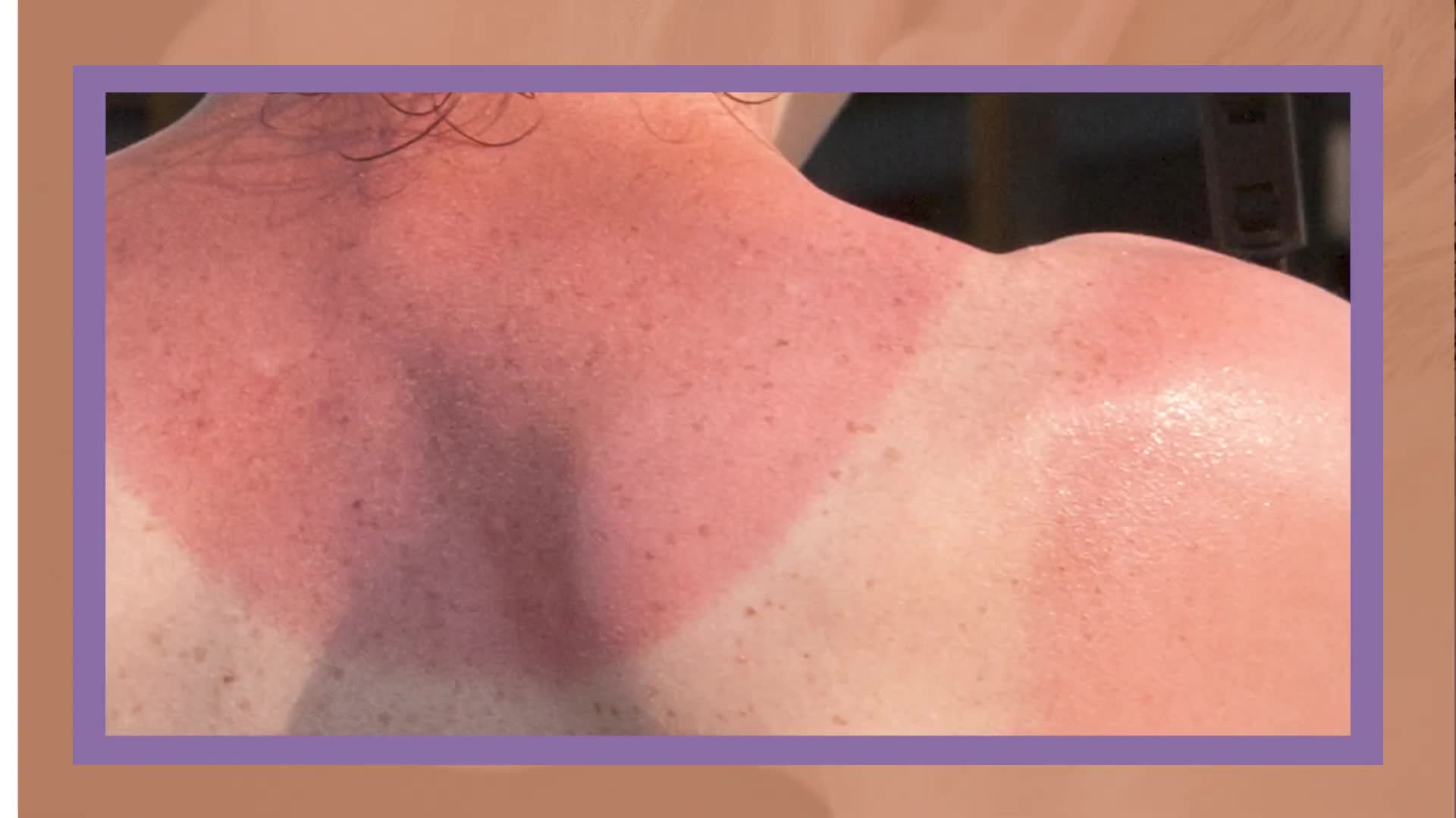 Understanding sun protection spf uva uvb dermatologist essential education