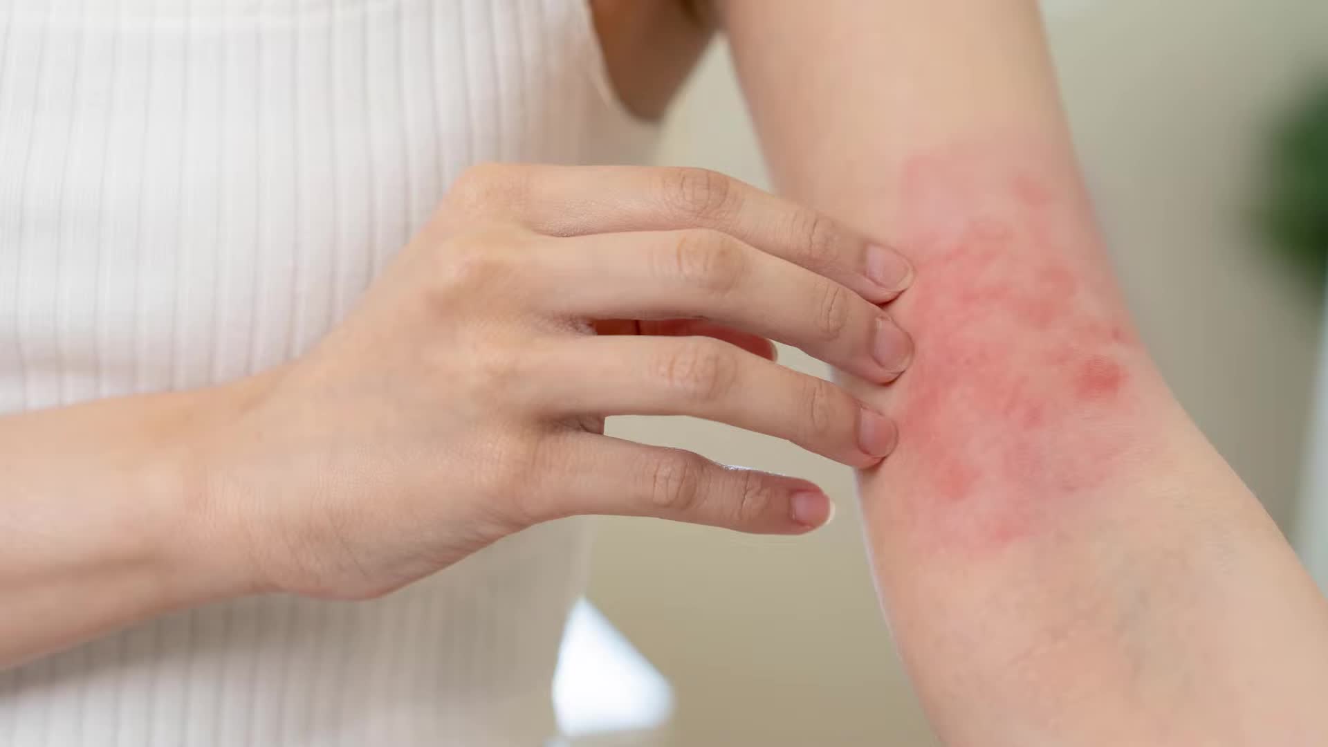 Top eczema remedies and best products dermatologist treatment guide