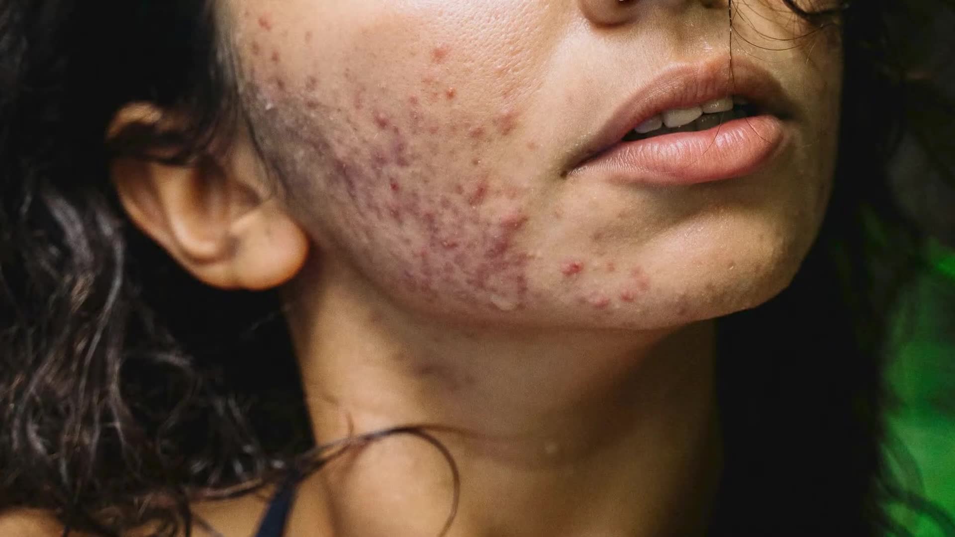 Complete isotretinoin treatment guide from experienced dermatologist