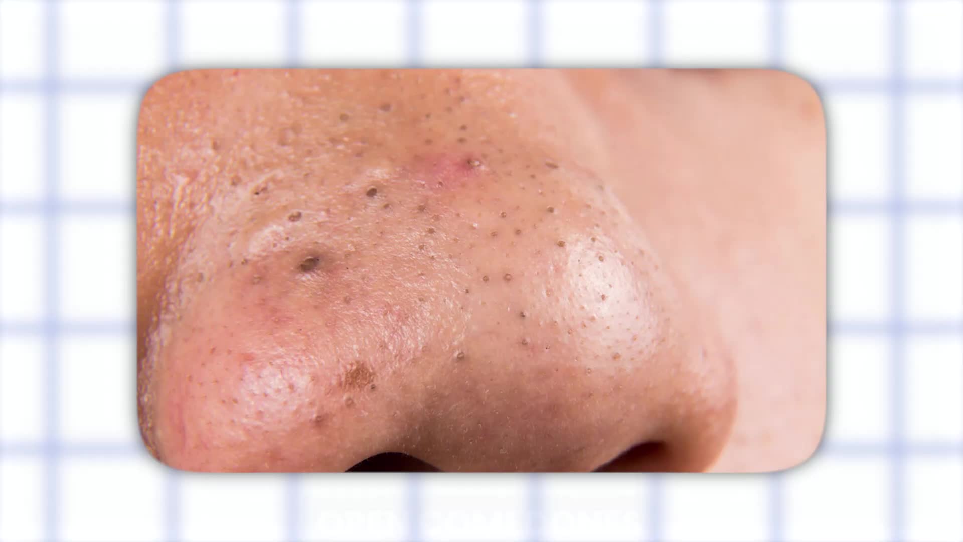 Persistent blackhead underlying causes and lasting solutions