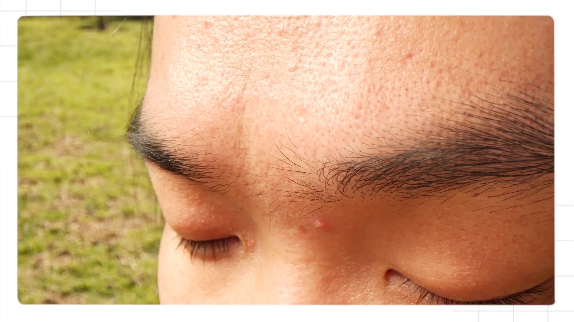 Acne classification system and causative factors explained