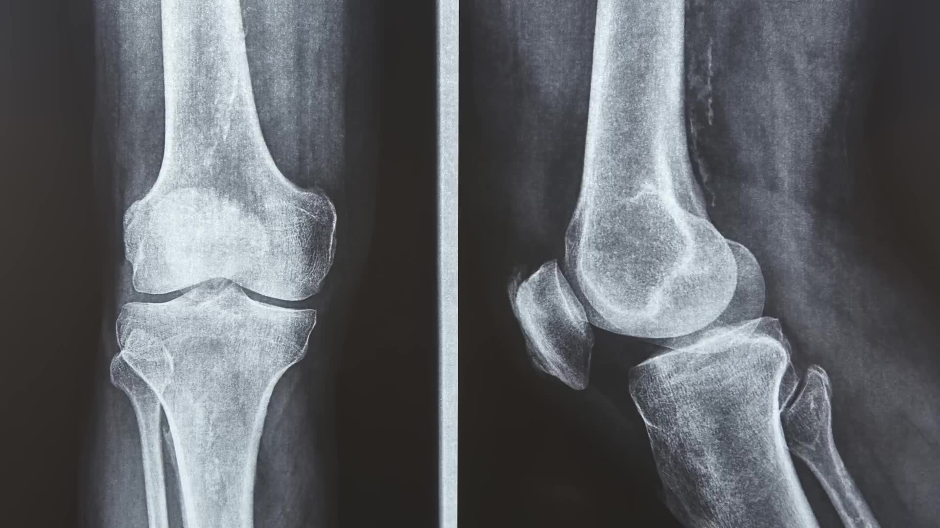 A surgeon's guide to understanding what your knee x-ray report actually means