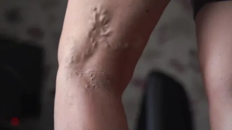 Treatment options for removing varicose veins