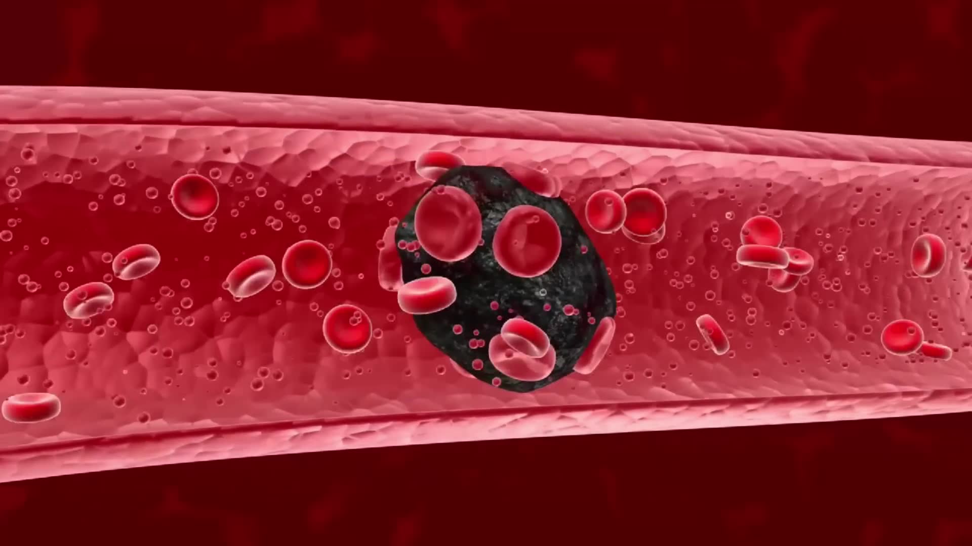 Do you have a blood clot or DVT signs & symptoms