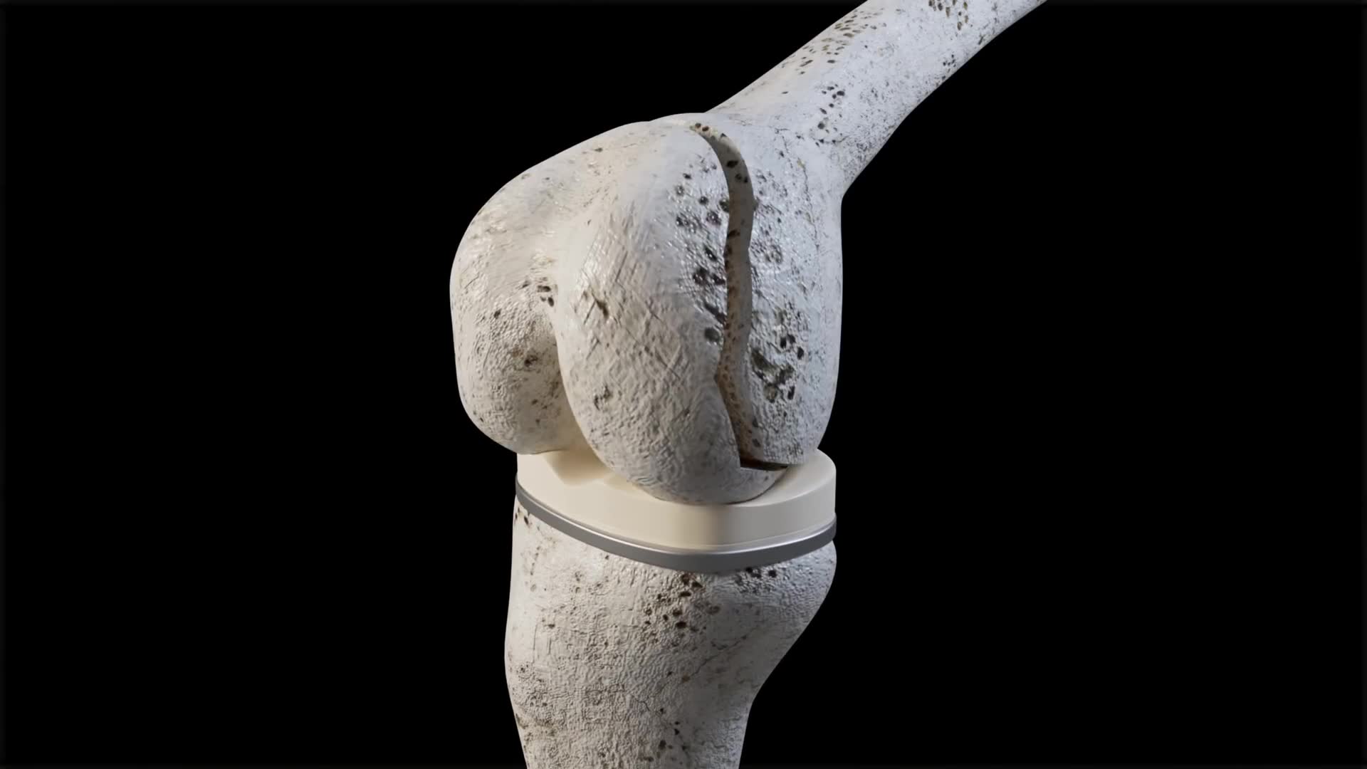 The goals of knee replacement surgery mistake that could affect your long-term health