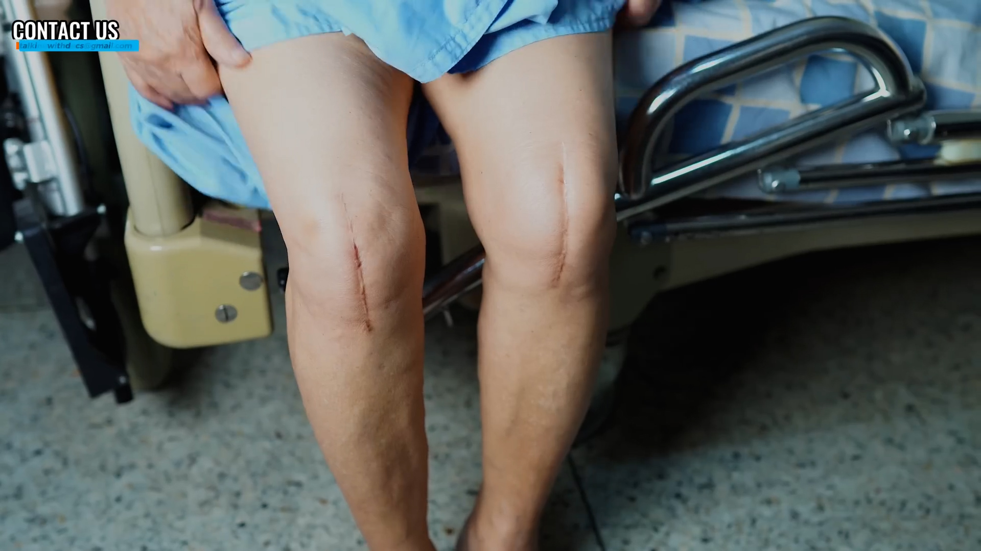 What orthopedic surgeons actually recommend for going home same day after knee