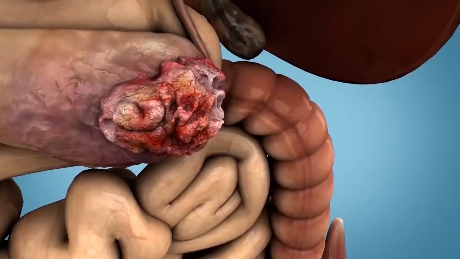 Gastroenterologists explain how to manage get rid of gallstones without surgery the right way