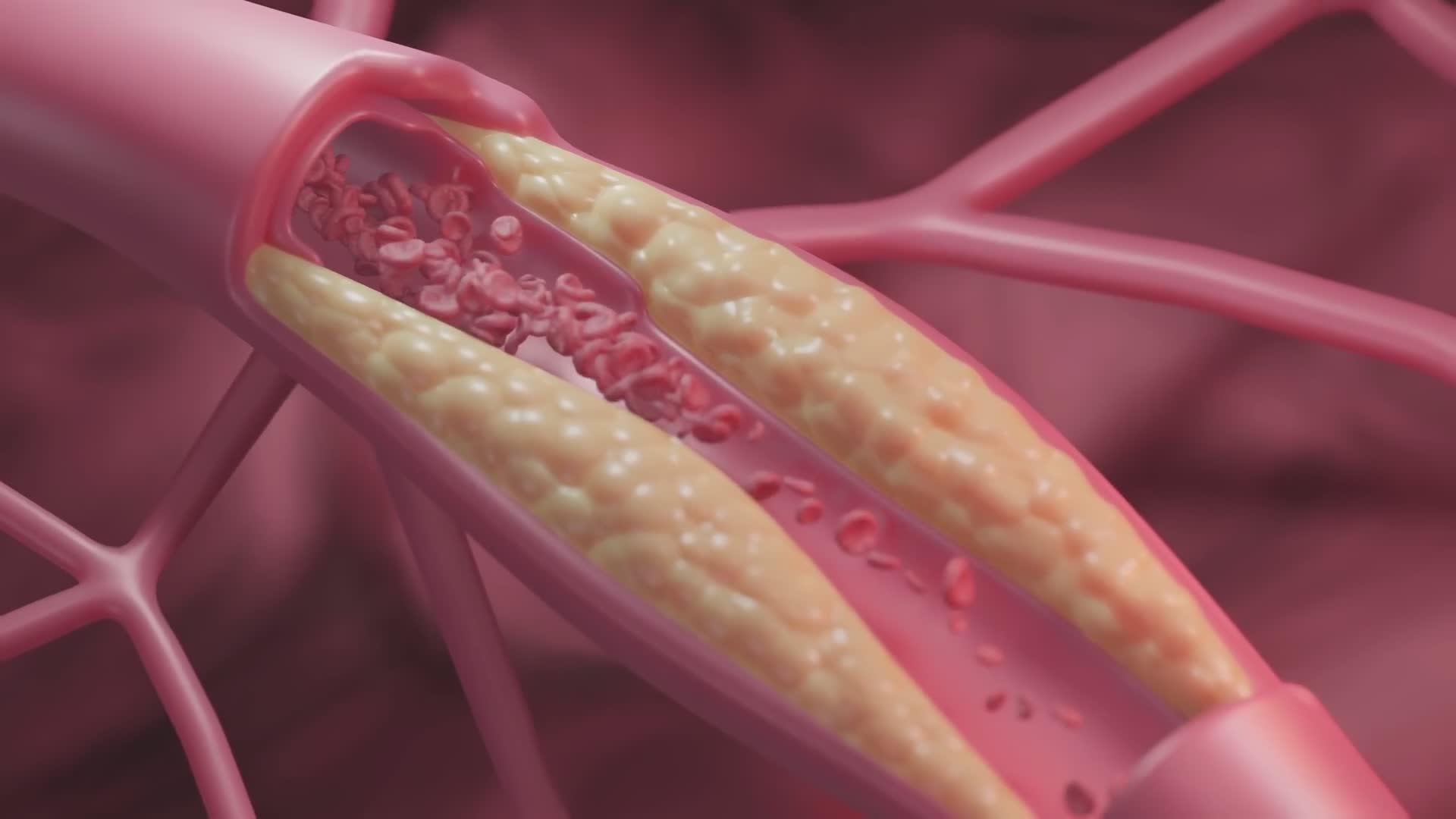 Doctors warn about a newly identified and more dangerous type of cholesterol
