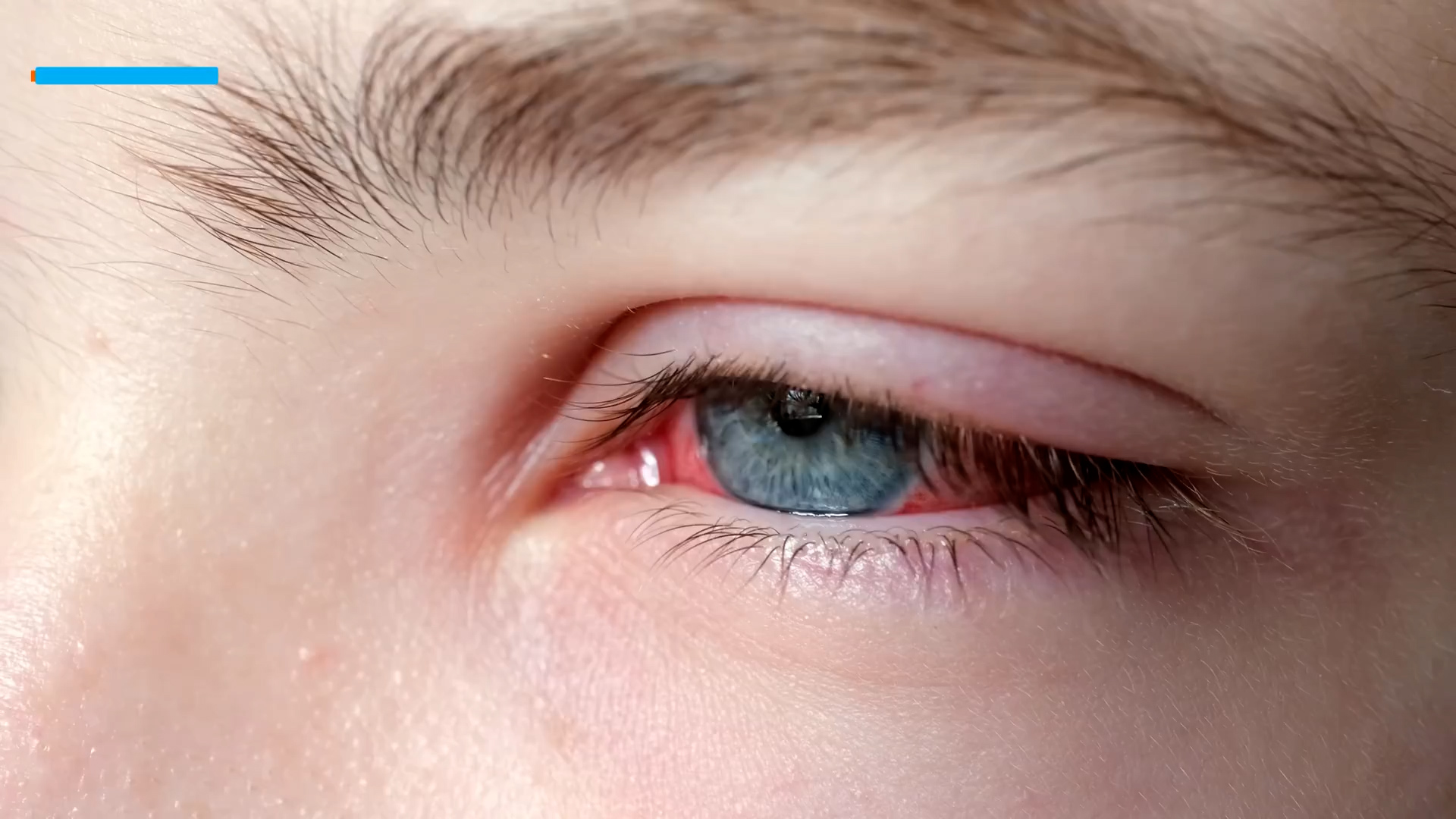 Why doctors are talking about subconjunctival hemorrhage and what it means