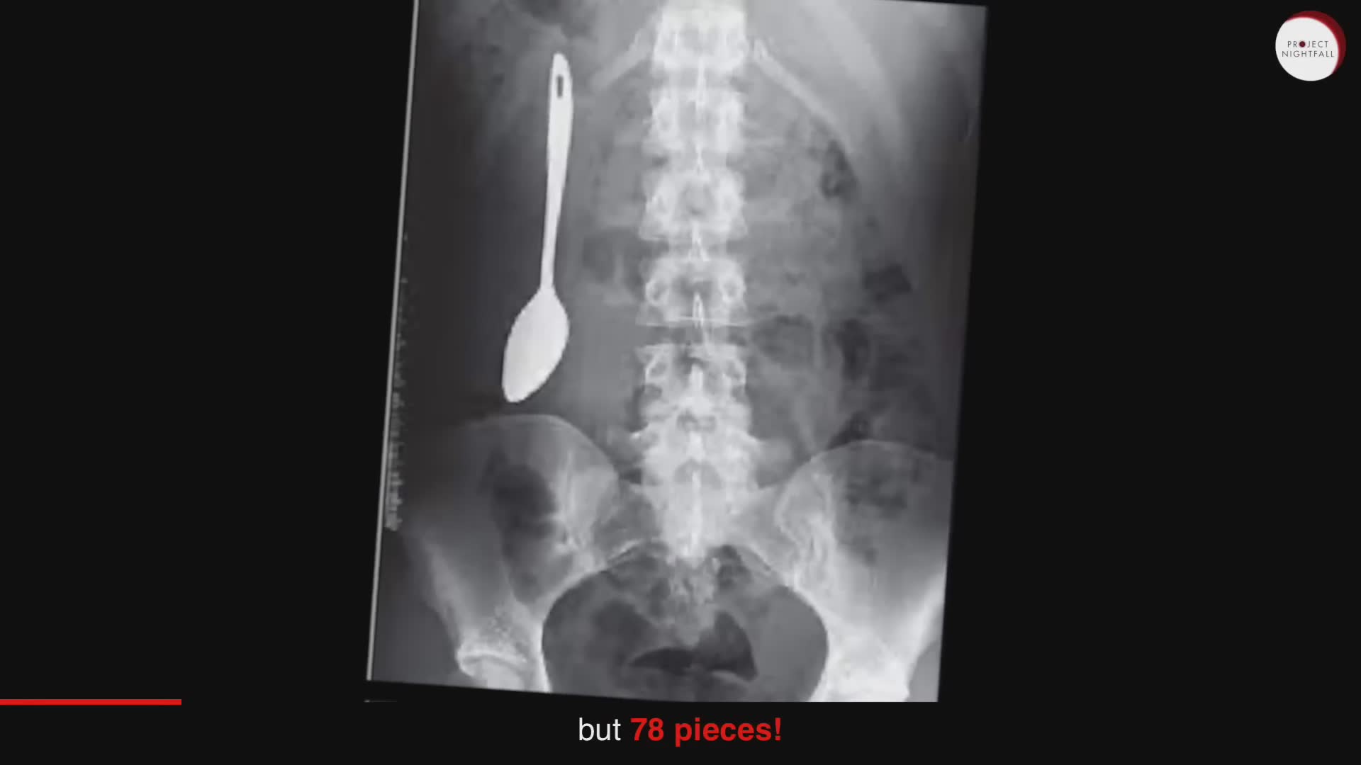 Most shocking things found inside a human body