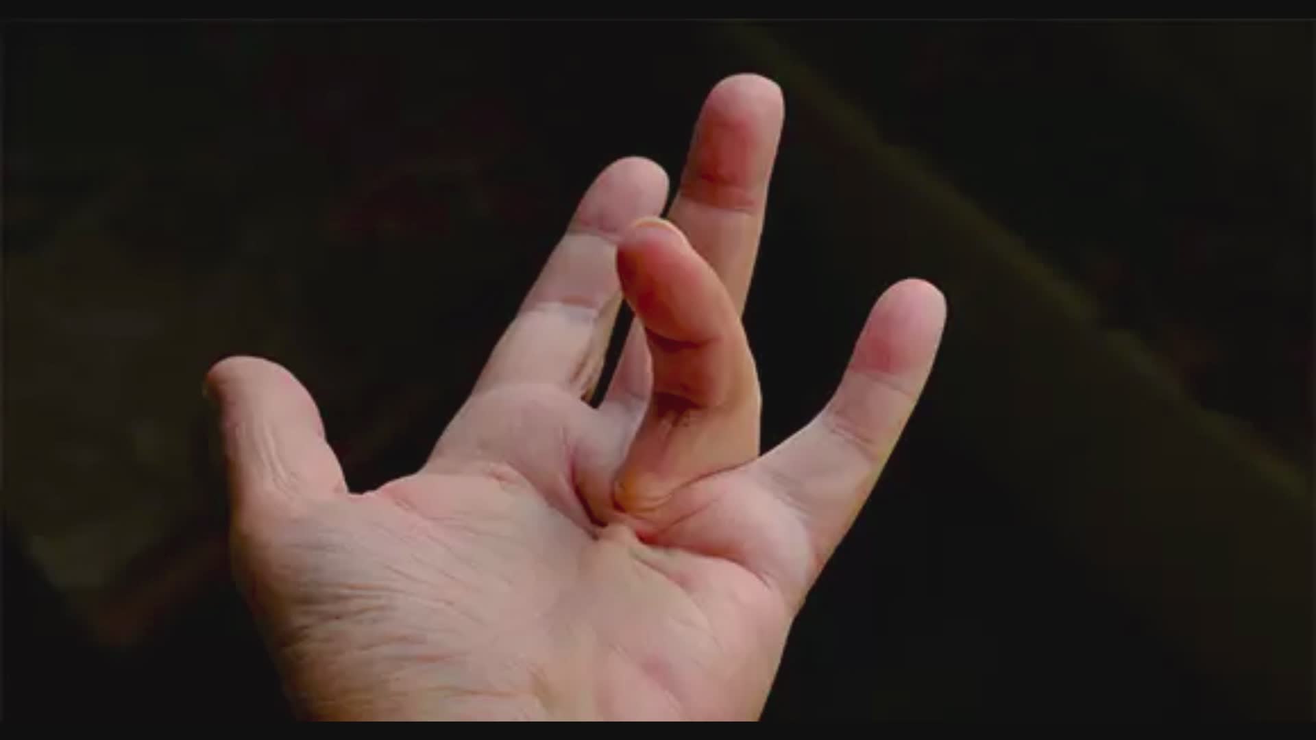 Are Your Fingers Curving Dupuytren's Contracture | Doctors explain