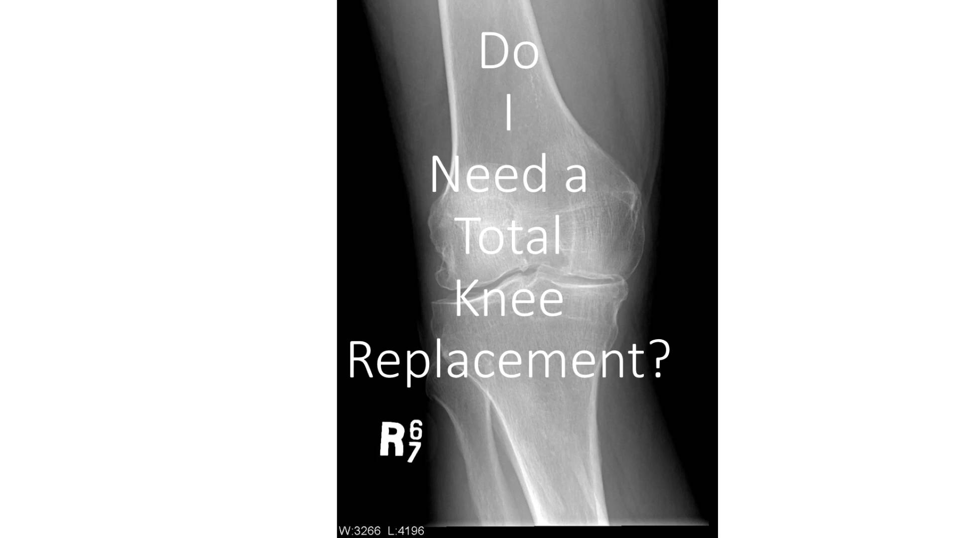 How to know if you need a knee replacement