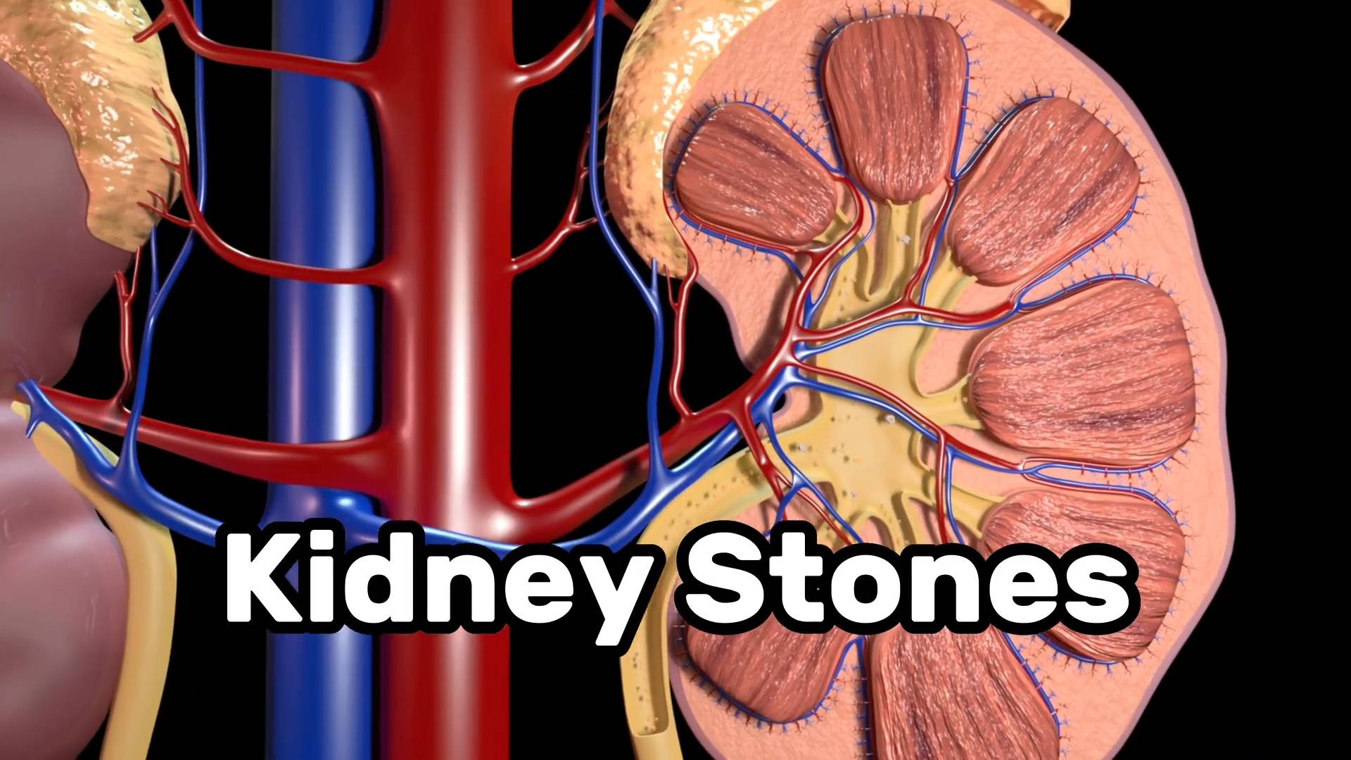Kidney stones treatments and why you get them